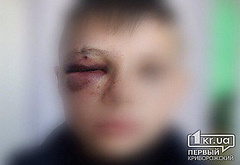 В Кривом Роге в Саксаганском районе мужчина ударил в лицо 11-летнего школьника, в результате чего ребенка госпитализировали с закрытой черепно-мозговой травмой.