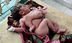 В индийском штате Раджастан родился ребенок с четырьмя ногами и тремя руками.